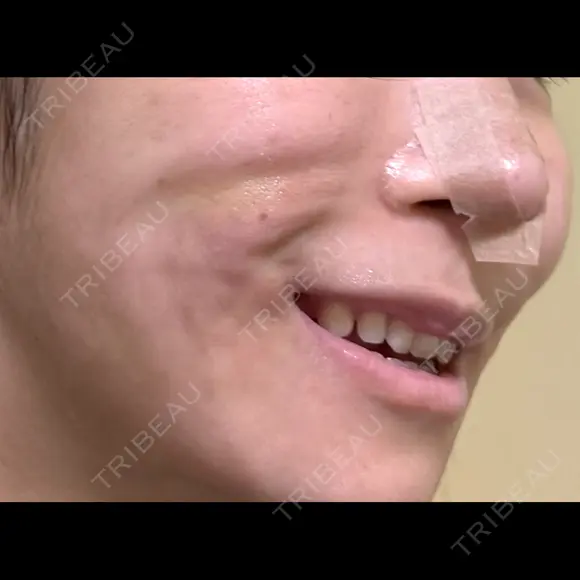 糸リフト / 脂肪吸引（顔） / ジョールファット除去 / ボトックス（エラ・小顔） 新宿美容外科ネビュラクリニック DAY 52 メイン用