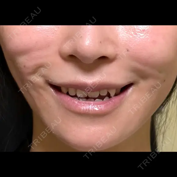 糸リフト / 脂肪吸引（顔） / ジョールファット除去 / ボトックス（エラ・小顔） 新宿美容外科ネビュラクリニック AFTER メイン用