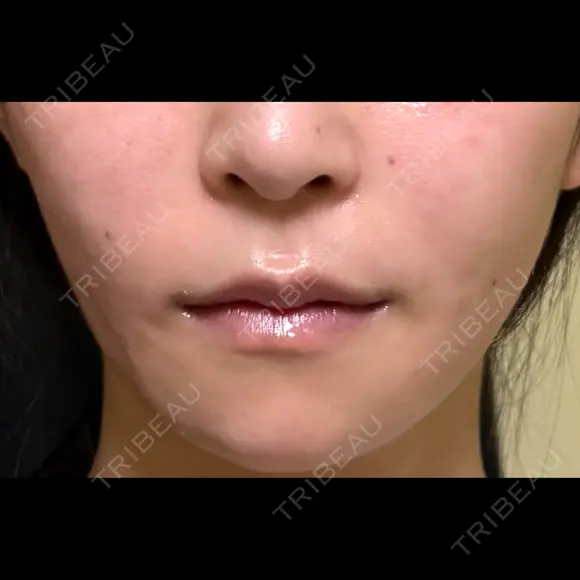糸リフト / 脂肪吸引（顔） / ジョールファット除去 / ボトックス（エラ・小顔） 新宿美容外科ネビュラクリニック DAY 57 メイン用
