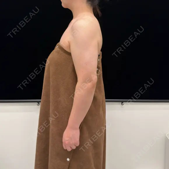 脂肪吸引（二の腕） EMMA CLINIC（エマクリニック） DAY 98 メイン用