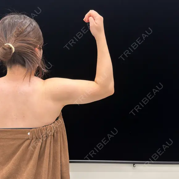 脂肪吸引（二の腕） EMMA CLINIC（エマクリニック） DAY 98 メイン用