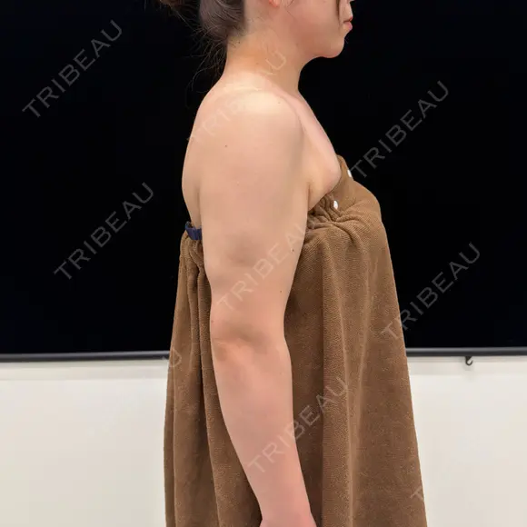 脂肪吸引（二の腕） EMMA CLINIC（エマクリニック） AFTER メイン用