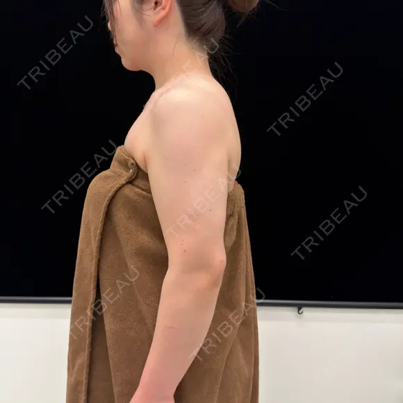 脂肪吸引（二の腕） EMMA CLINIC（エマクリニック） DAY 189 メイン用