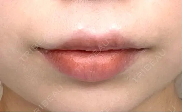 口唇縮小術 博多美容外科/美容皮膚科 ビラビューティークリニック AFTER メイン用