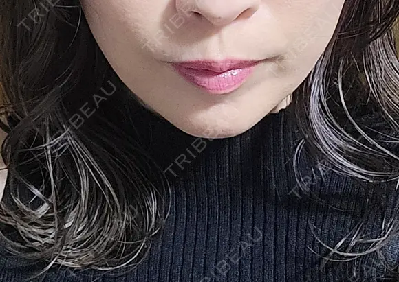 ボトックス（口角） eクリニック 岡山院 AFTER メイン用