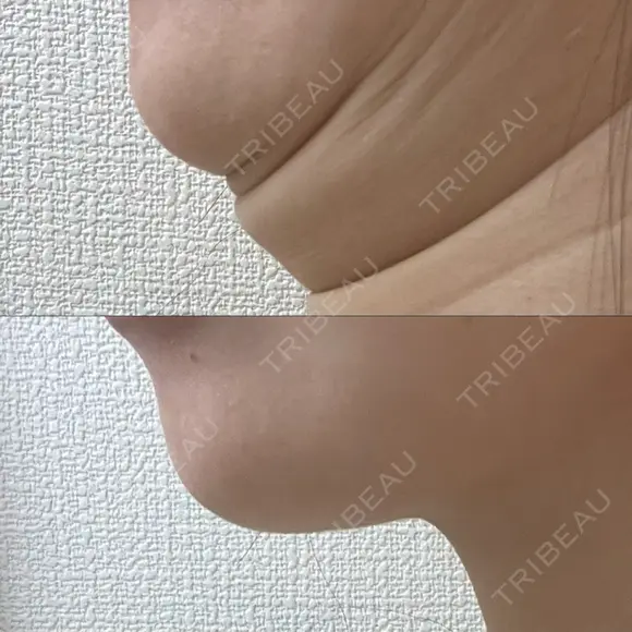 その他（輪郭） 美容皮膚科エルムクリニック 大阪院 DAY 35 メイン用