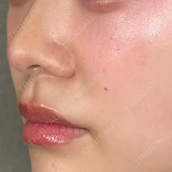 小鼻縮小（切開） / 口角挙上 アリエル美容クリニック 大宮院 DAY 194 メイン用