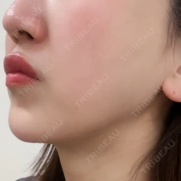 インモード BISIN GINZA CLINIC DAY 2 メイン用