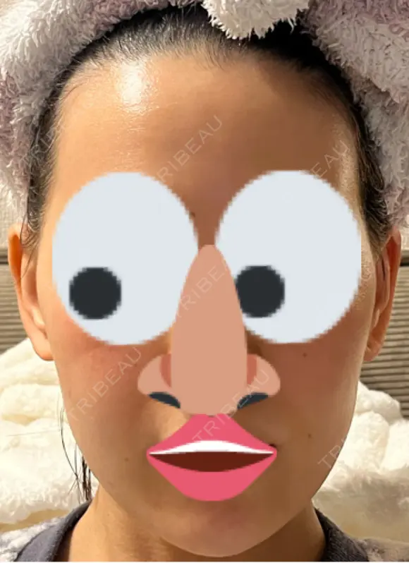 インモード PureMe Skin Clinic（ピュアミースキンクリニック麻布） DAY 2 メイン用