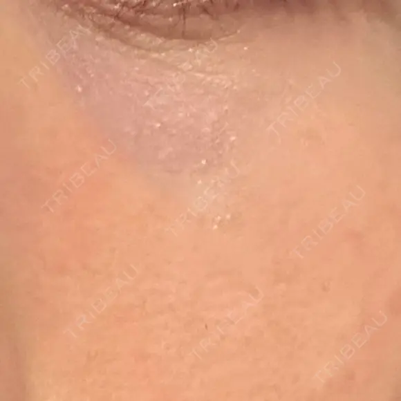 その他（目元） 品川スキンクリニック広島院 DAY 8 メイン用