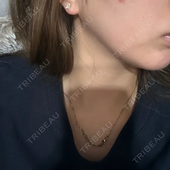 糸リフト / 脂肪吸引（顔） / 水光注射（ハリ・美肌） Wing clinic 豊中駅前院 DAY 57 メイン用