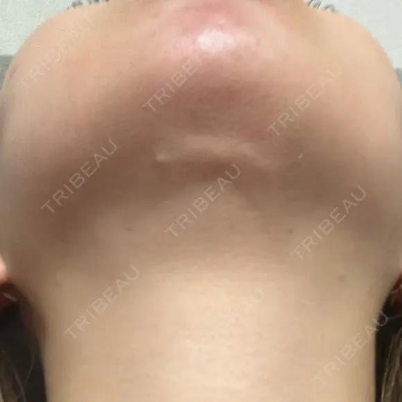 糸リフト / 脂肪吸引（顔） / 水光注射（ハリ・美肌） Wing clinic 豊中駅前院 DAY 57 メイン用