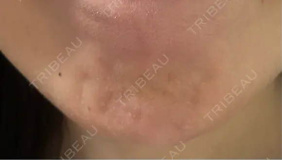 ボトックス（あご） 池袋美容クリニック AFTER メイン用