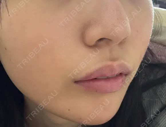 ハイフ（顔） Natural Skin Clinic 自由ヶ丘院 AFTER メイン用
