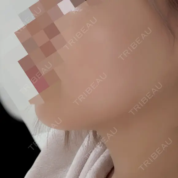 ハイフ（顔） Natural Skin Clinic 自由ヶ丘院 AFTER メイン用