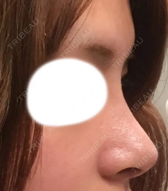 隆鼻術 / 鼻尖形成（切開） / 鼻中隔延長（切開） / 鼻尖縮小 FROM B整形外科 (旧バウム整形外科) DAY 8 メイン用