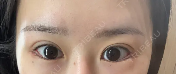 目尻切開 / タレ目形成・グラマラスライン（切開） BIANCA銀座 DAY 31 メイン用