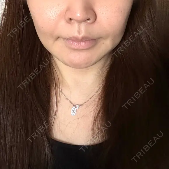 糸リフト A CLINIC（エークリニック） 横浜院 AFTER メイン用