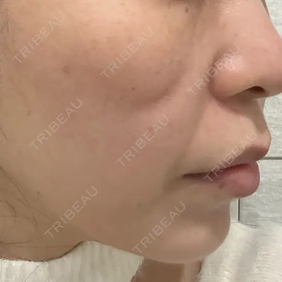 ピコレーザートーニング（美白・肝斑） APスキンクリニック銀座 DAY 0 メイン用