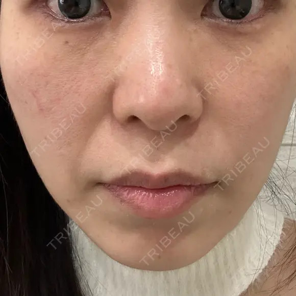 ピコレーザートーニング（美白・肝斑） APスキンクリニック銀座 AFTER メイン用