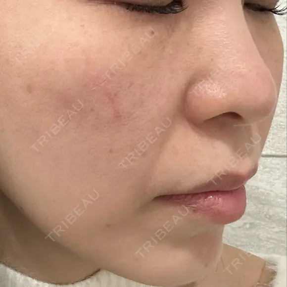 ピコレーザートーニング（美白・肝斑） APスキンクリニック銀座 DAY 0 メイン用