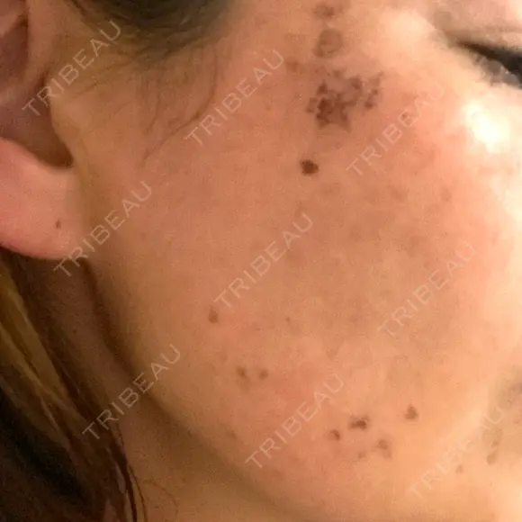 シミ取りレーザー S-Laboクリニック 渋谷院 DAY 7 メイン用