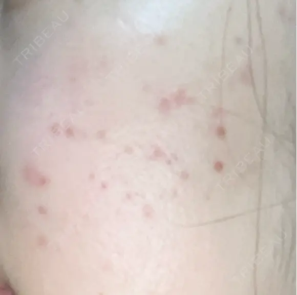 その他（肌） / ポテンツァ ルラ美容クリニック 郡山院 DAY 14 メイン用