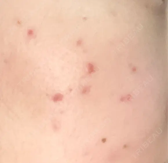 その他（肌） / ポテンツァ ルラ美容クリニック 郡山院 DAY 14 メイン用