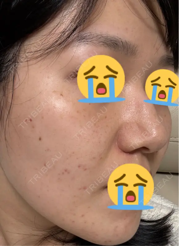 美肌レーザー / LDM・インテンスウルトラ ライズワン美容皮膚科クリニック DAY 2 メイン用