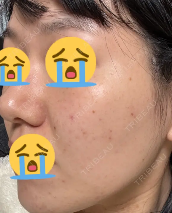 美肌レーザー / LDM・インテンスウルトラ ライズワン美容皮膚科クリニック DAY 2 メイン用