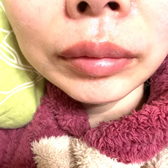 ヒアルロン酸注入（唇） KIMI CLINIC 形成・美容外科 AFTER メイン用