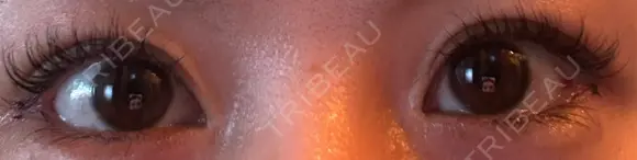 目尻切開 / タレ目形成・グラマラスライン（埋没） LOUIS CLINIC 二子玉川院【ルイクリニック】 DAY 5 メイン用