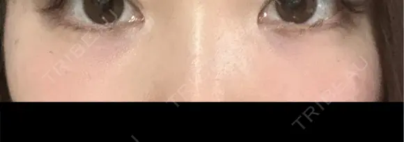 ベビーコラーゲン AI Beauty Clinic （エーアイ美容クリニック） AFTER メイン用
