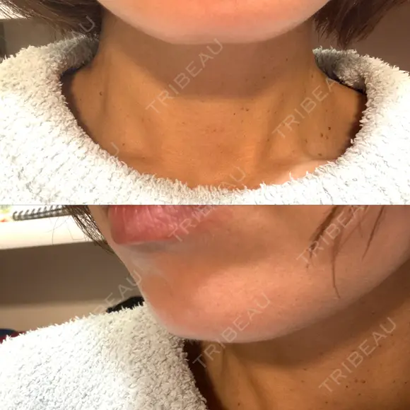 デンシティ 城本クリニック 新宿院 DAY 1 メイン用