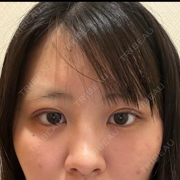 二重埋没 湘南美容クリニック 千葉センシティ院 DAY 0 メイン用