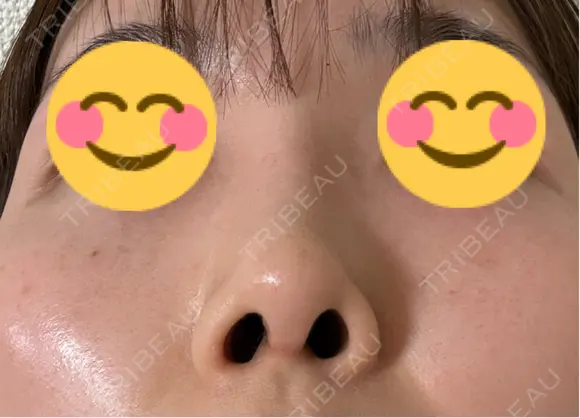 鼻尖形成（切開） / 鼻中隔延長（切開） / 軟骨移植 / 眉間プロテーゼ eクリニック 福岡院 DAY 48 メイン用