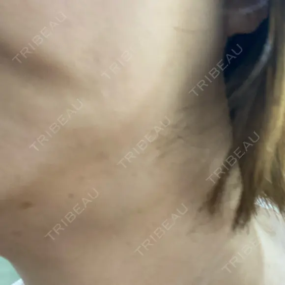 ヒアルロン酸溶解 / インモード Moon Beauty Clinic AFTER メイン用