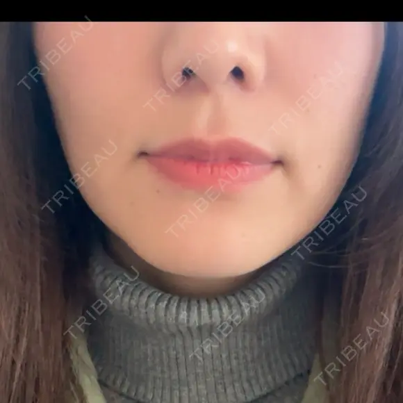 オンダリフト RIVER CLINIC（リバークリニック） AFTER メイン用