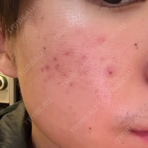 フラクショナルレーザー（毛穴・ニキビ跡） しらゆりメディカルクリニック （旧しらゆりビューティークリニック） DAY 0 メイン用