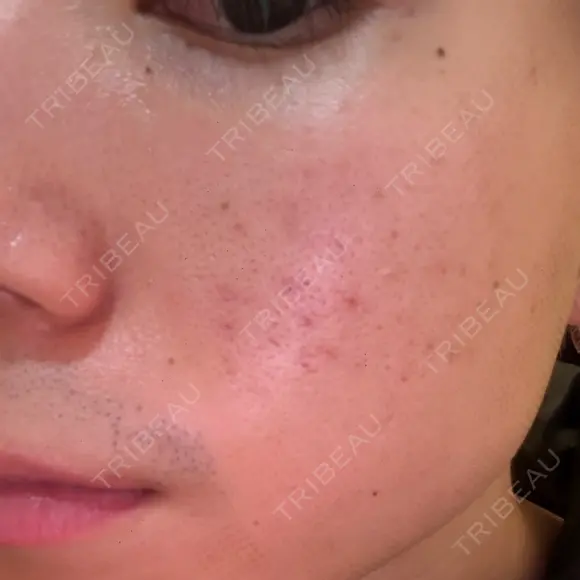 フラクショナルレーザー（毛穴・ニキビ跡） しらゆりメディカルクリニック （旧しらゆりビューティークリニック） DAY 0 メイン用