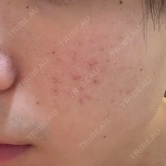 フラクショナルレーザー（毛穴・ニキビ跡） しらゆりメディカルクリニック （旧しらゆりビューティークリニック） DAY 4 メイン用