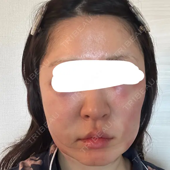 脂肪吸引注射（顔） 新宿美容外科ネビュラクリニック DAY 1 メイン用