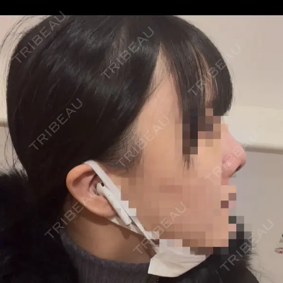 鼻尖形成（切開） / 軟骨移植 / 眉間プロテーゼ BAYASHI CLINIC DAY 3 メイン用