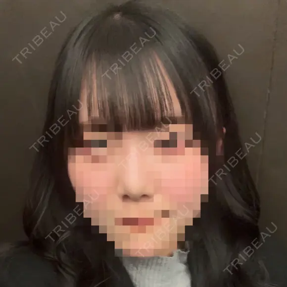 鼻尖形成（切開） / 軟骨移植 / 眉間プロテーゼ BAYASHI CLINIC AFTER メイン用