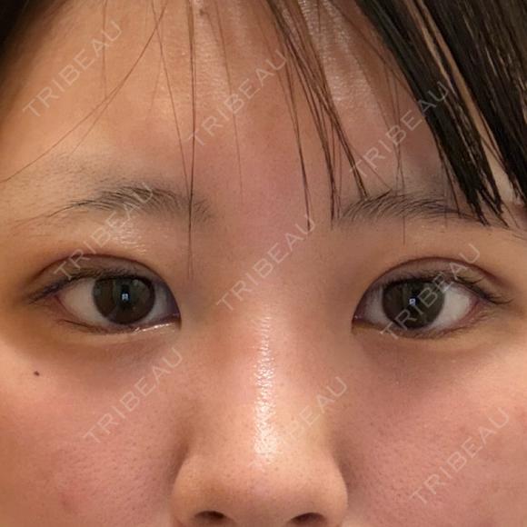 二重埋没 湘南美容クリニック 千葉センシティ院 DAY 1 メイン用