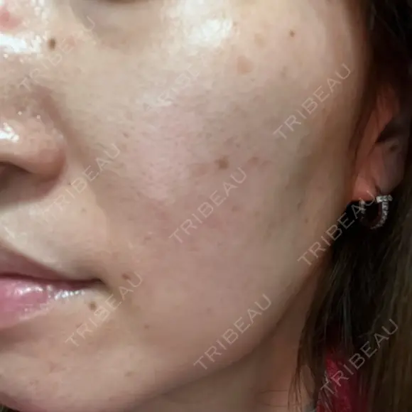光治療（フォトフェイシャルなど） しんゆり美容健康クリニック DAY 0 メイン用
