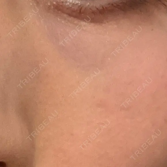 その他（目元） 品川スキンクリニック広島院 DAY 11 メイン用