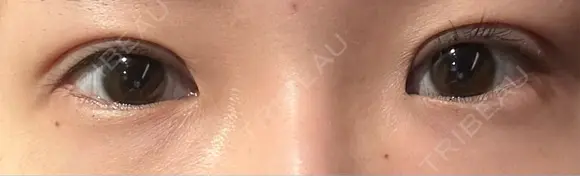 眼瞼下垂（切開） 聖心美容クリニック 六本木院 DAY 21 メイン用