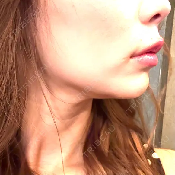 ボトックス（あご） / ボトックス（エラ・小顔） DMTC CLINIC 渋谷院 AFTER メイン用