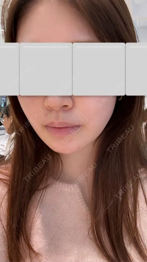 バッカルファット除去 / 脂肪吸引（顔） First Clinic AFTER メイン用